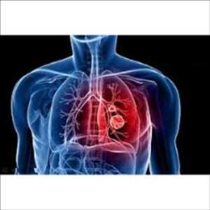 Systèmes d'administration de médicaments pulmonaires