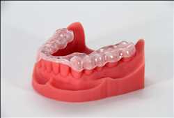 Marché de l'impression 3D dentaire