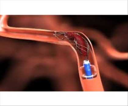Stents neurovasculaires marché
